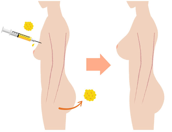 Come funziona il lipofilling seno