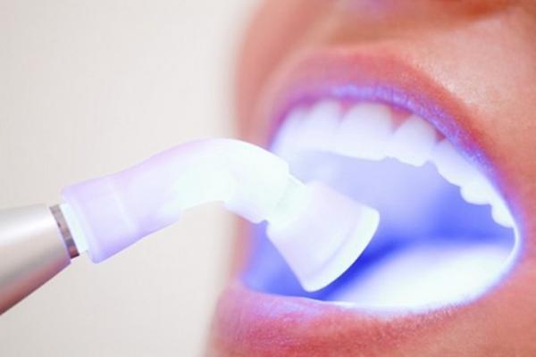 sbiancamento laser denti