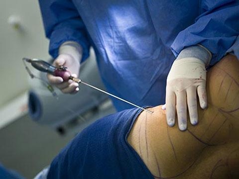 incisioni liposuzione e liposcultura