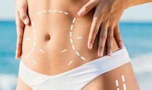 Body contouring dopo la dieta